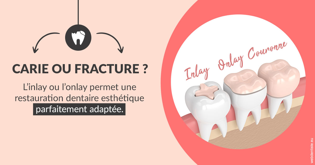 https://selarl-cabinet-dentaire-deberdt.chirurgiens-dentistes.fr/T2 2023 - Carie ou fracture 2