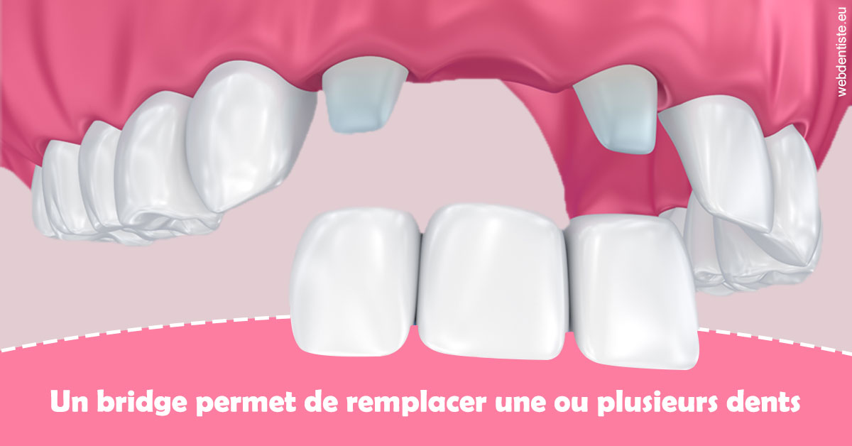 https://selarl-cabinet-dentaire-deberdt.chirurgiens-dentistes.fr/Bridge remplacer dents 2