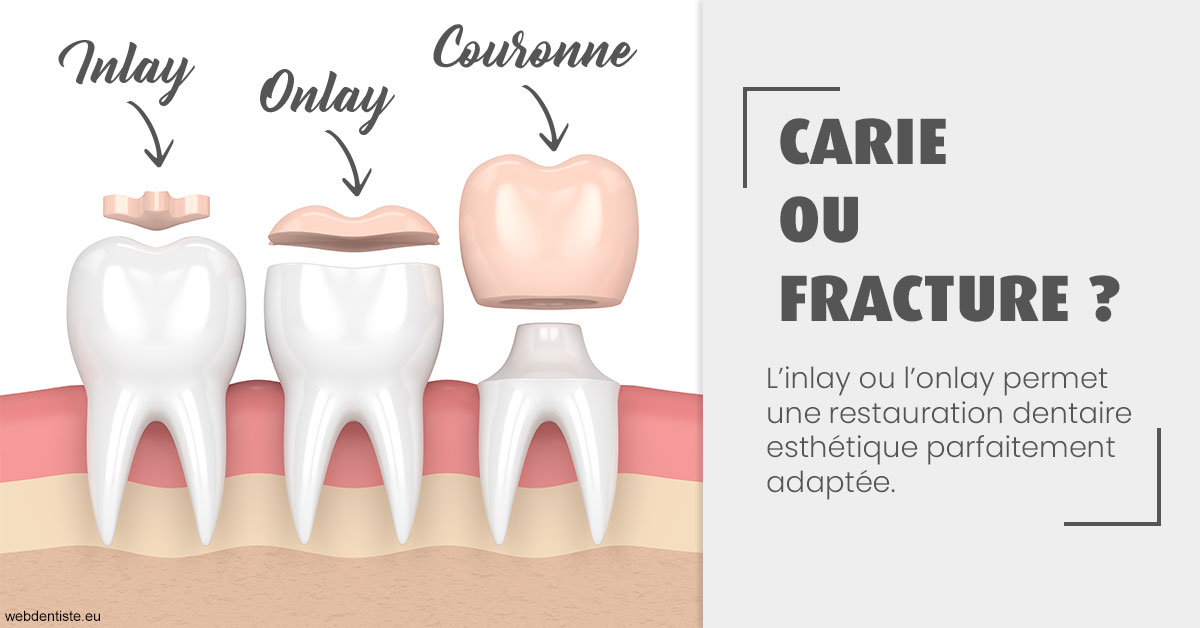https://selarl-cabinet-dentaire-deberdt.chirurgiens-dentistes.fr/T2 2023 - Carie ou fracture 1