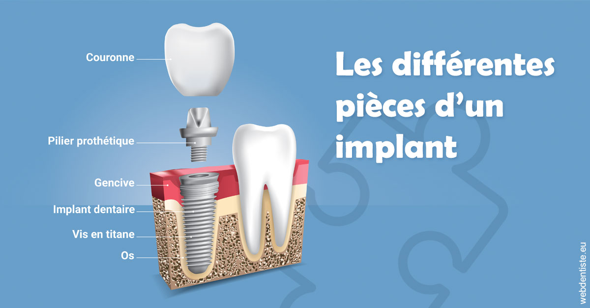 https://selarl-cabinet-dentaire-deberdt.chirurgiens-dentistes.fr/Les différentes pièces d’un implant 1